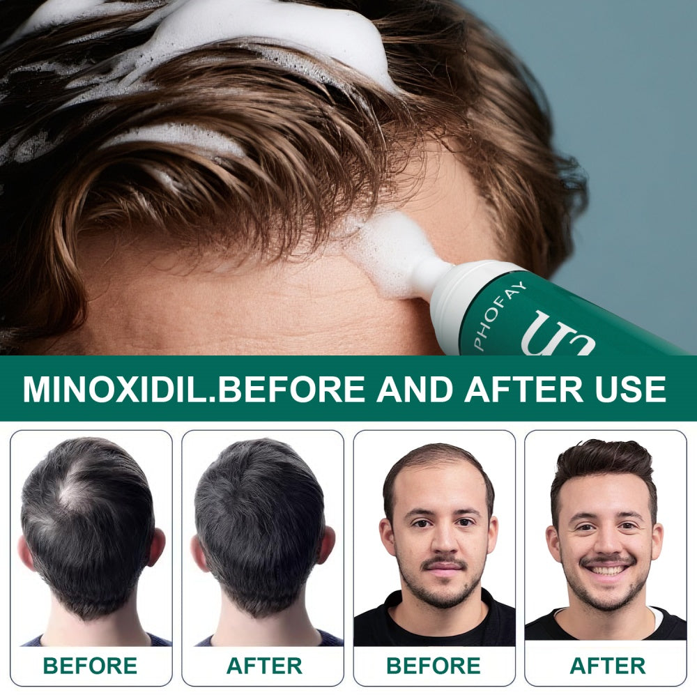 Phofay Minoxidil Anti-Hair Loss Mousse