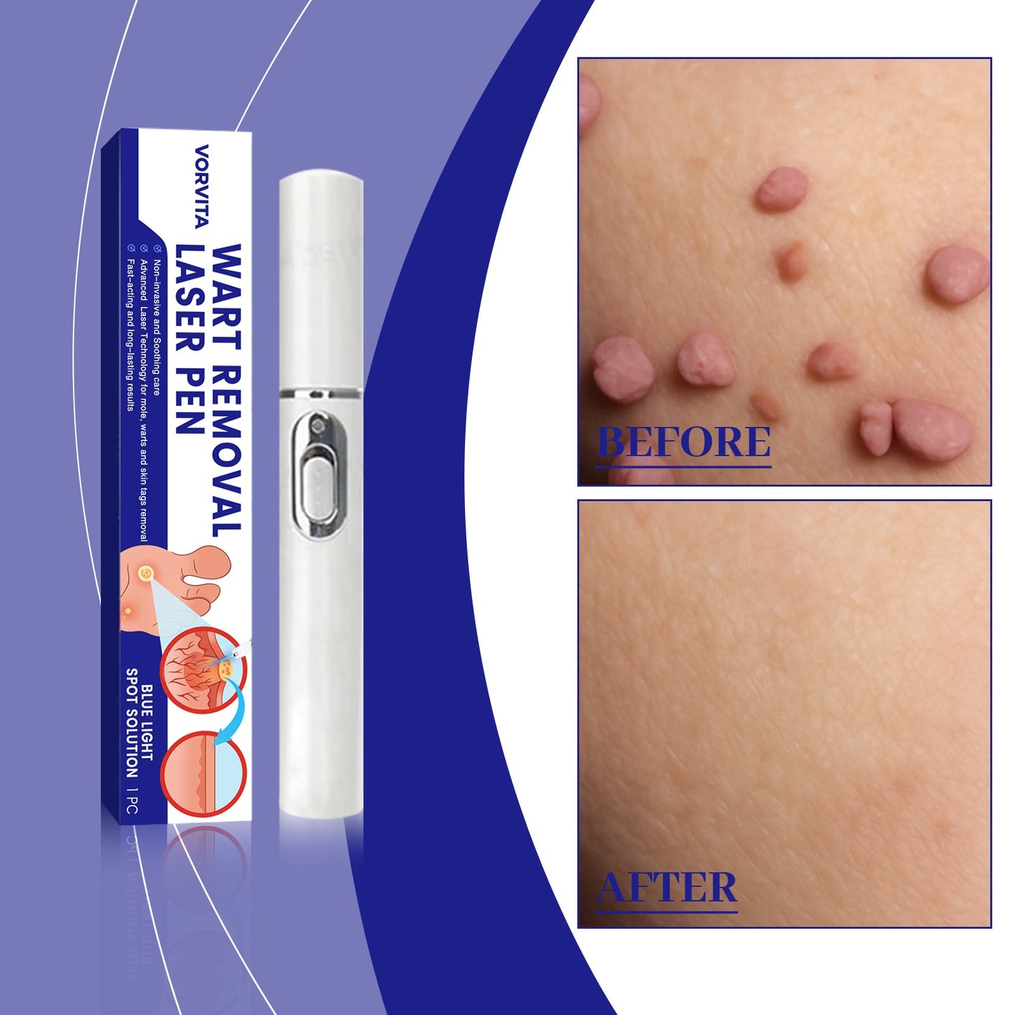 Skin Laser Care Pen 1pc